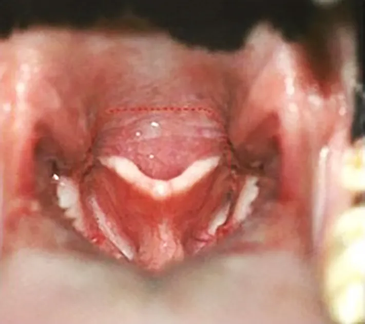 Before shortening of the soft palate after a B.O.S surgery