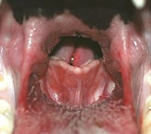 The results of shortening of the soft palate after a B.O.S surgery